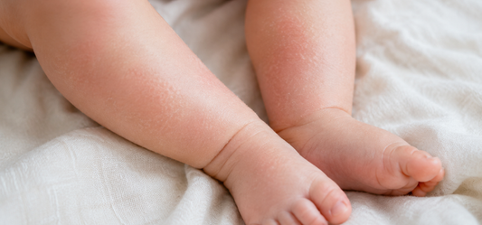 Pielea sensibilă a bebelușului — Tot ce trebuie să știi ca părinte, explicat de un dermatolog